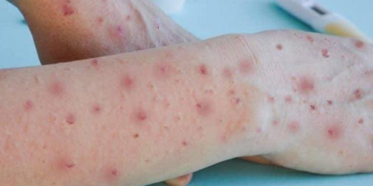 Paraíba confirma 1º caso de varíola dos macacos