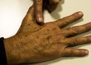 Sociedade médica lança campanha sobre prevenção do câncer de pele