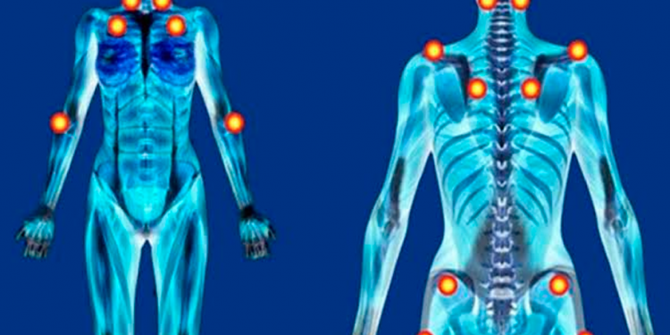 Pessoas com fibromialgia terão os mesmos direitos de deficientes, na PB