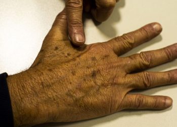 SUS aprova uso de luz para tratamento do câncer de pele