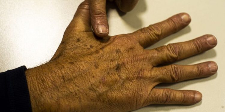 SUS aprova uso de luz para tratamento do câncer de pele